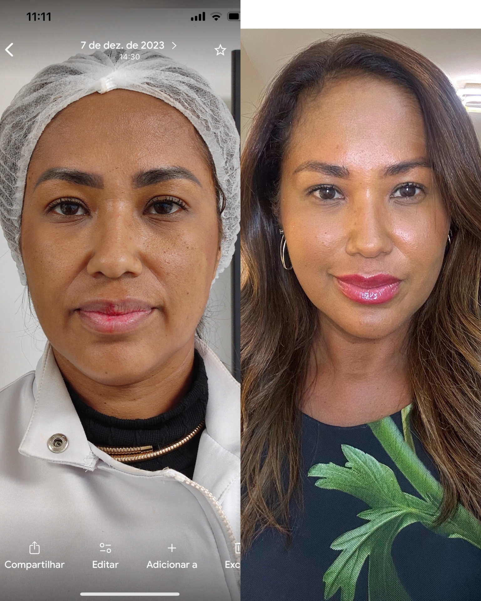Resultado antes e depois — paciente 02