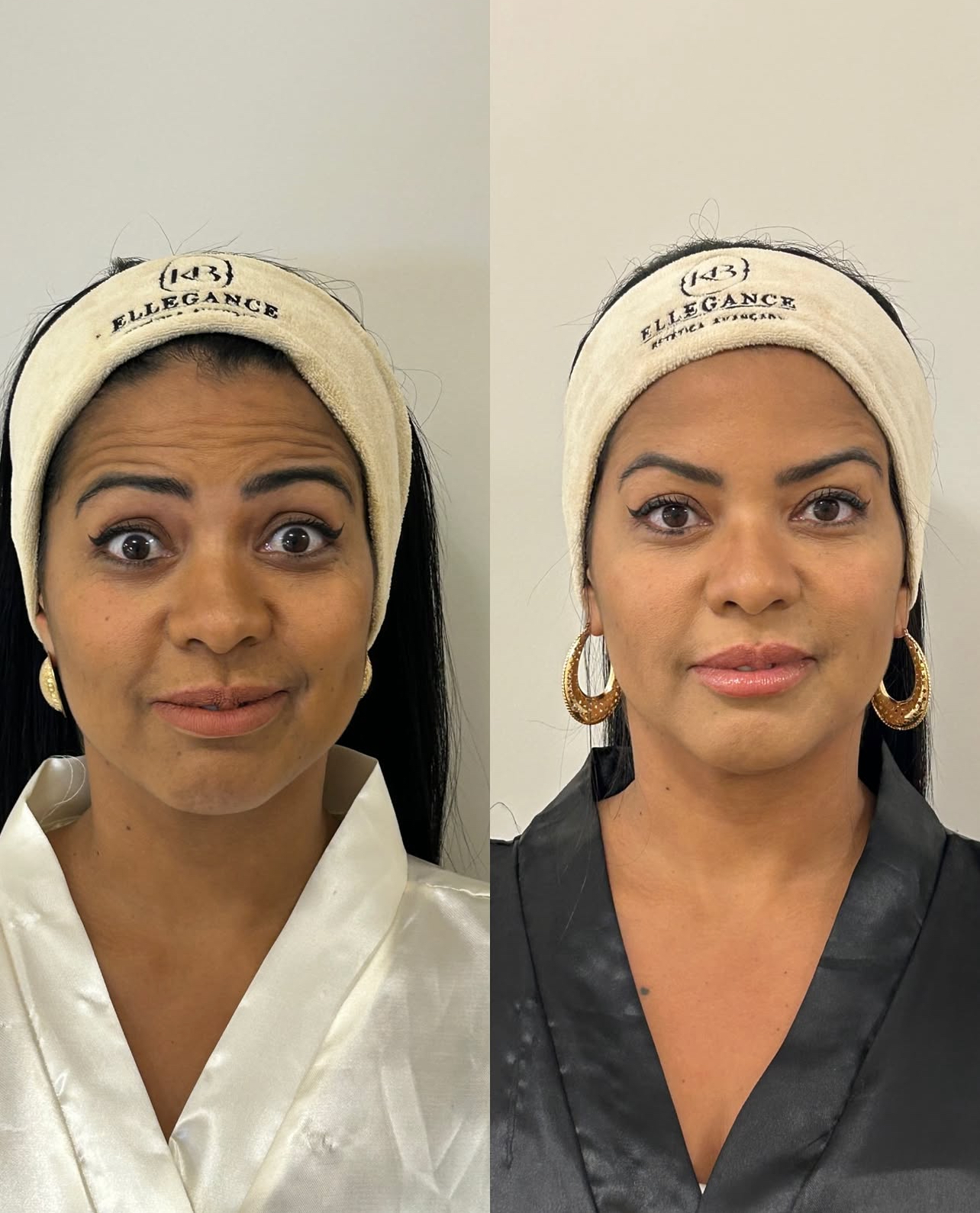 Resultado antes e depois — paciente 03