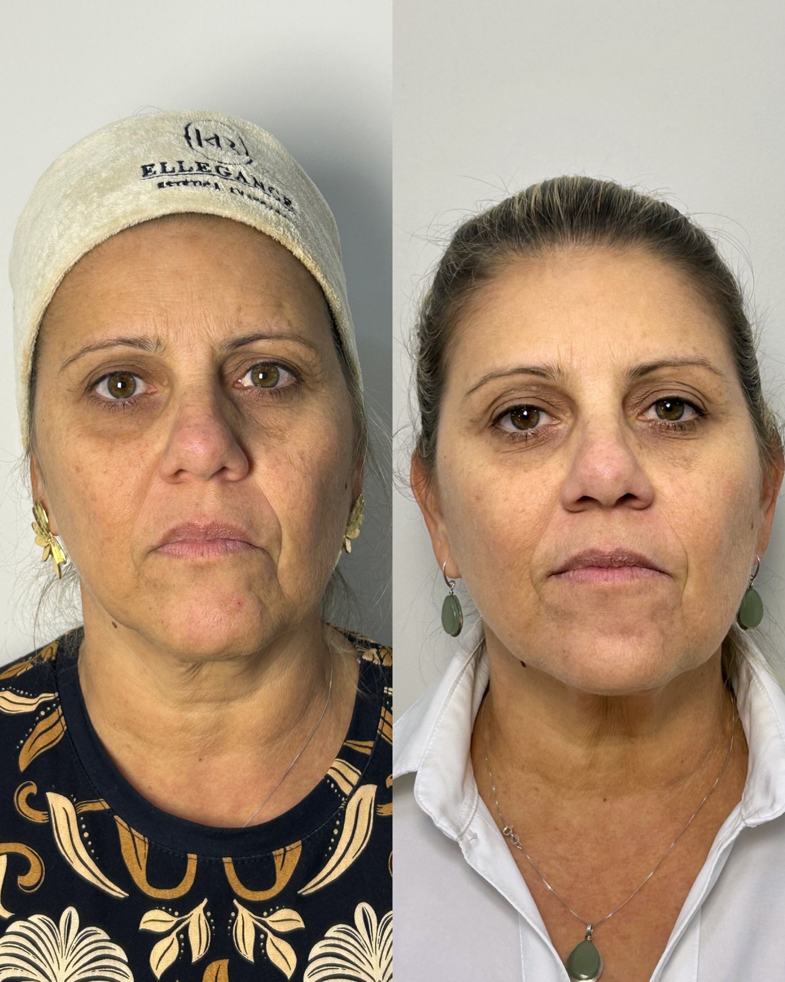 Resultado antes e depois — paciente 01